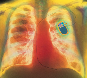 Un marcapasos implantado en un ser humano